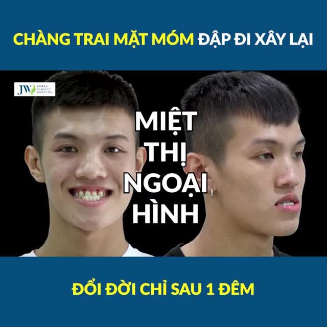 GIẬT MÌNH chàng trai phẫu thuật hàm móm CẮT HÀM DƯỚI, DỜI HÀM TRÊN đẹp trai sau 1 GIẤC NGỦ