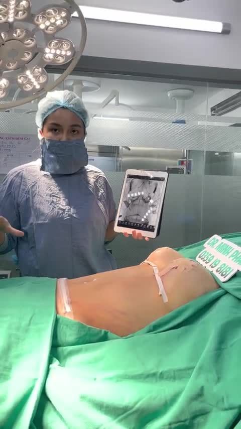 Ca combo Treo sa trễ độ 4 + hút mỡ THTB vừa được thực hiện bởi ekip Dr. Minh Phạm