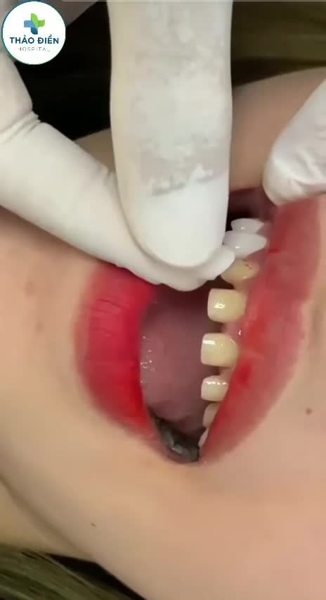MẶT DÁN SỨ VENEER - GIẢI PHÁP BỌC RĂNG SỨ THỜI THƯỢNG VÀ CAO CẤP