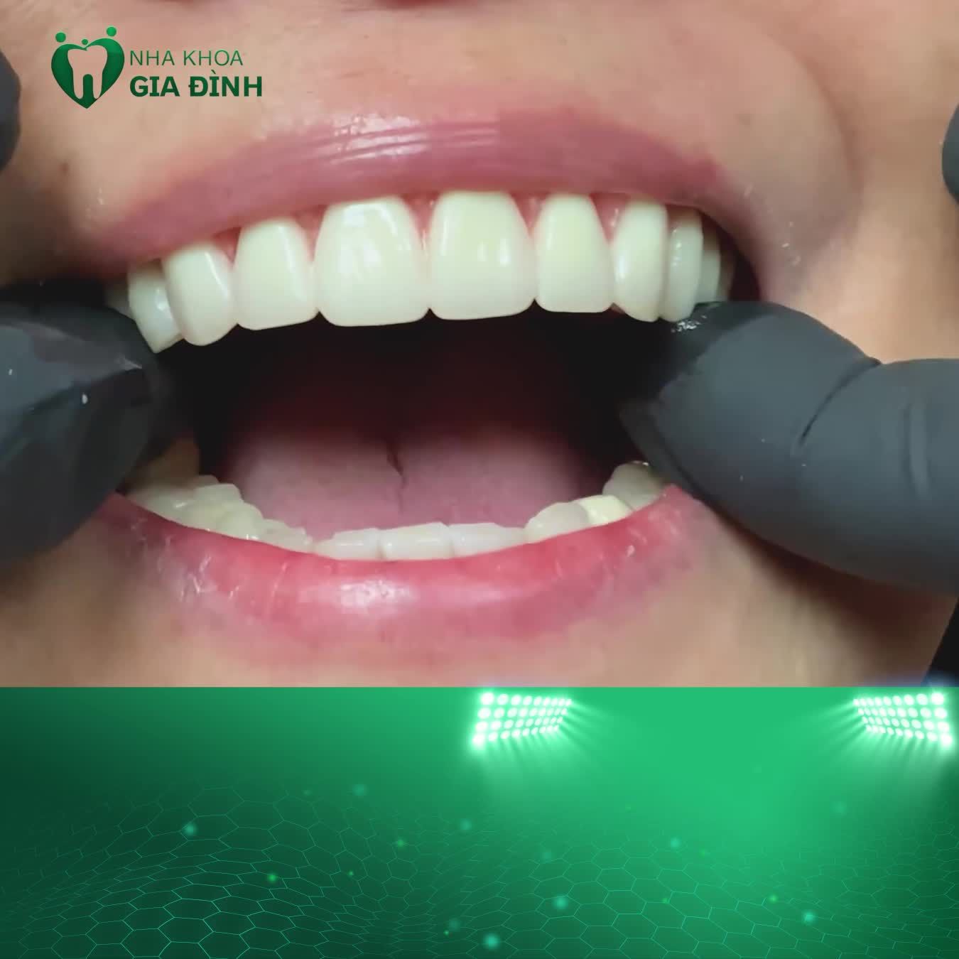 CÔ CHÚ ANH CHỊ MẤT RĂNG KHÔNG CẦN LO LẮNG  HÀM GIẢ THÁO LẮP LẤY LẠI CẢM GIÁC ĂN NHAI