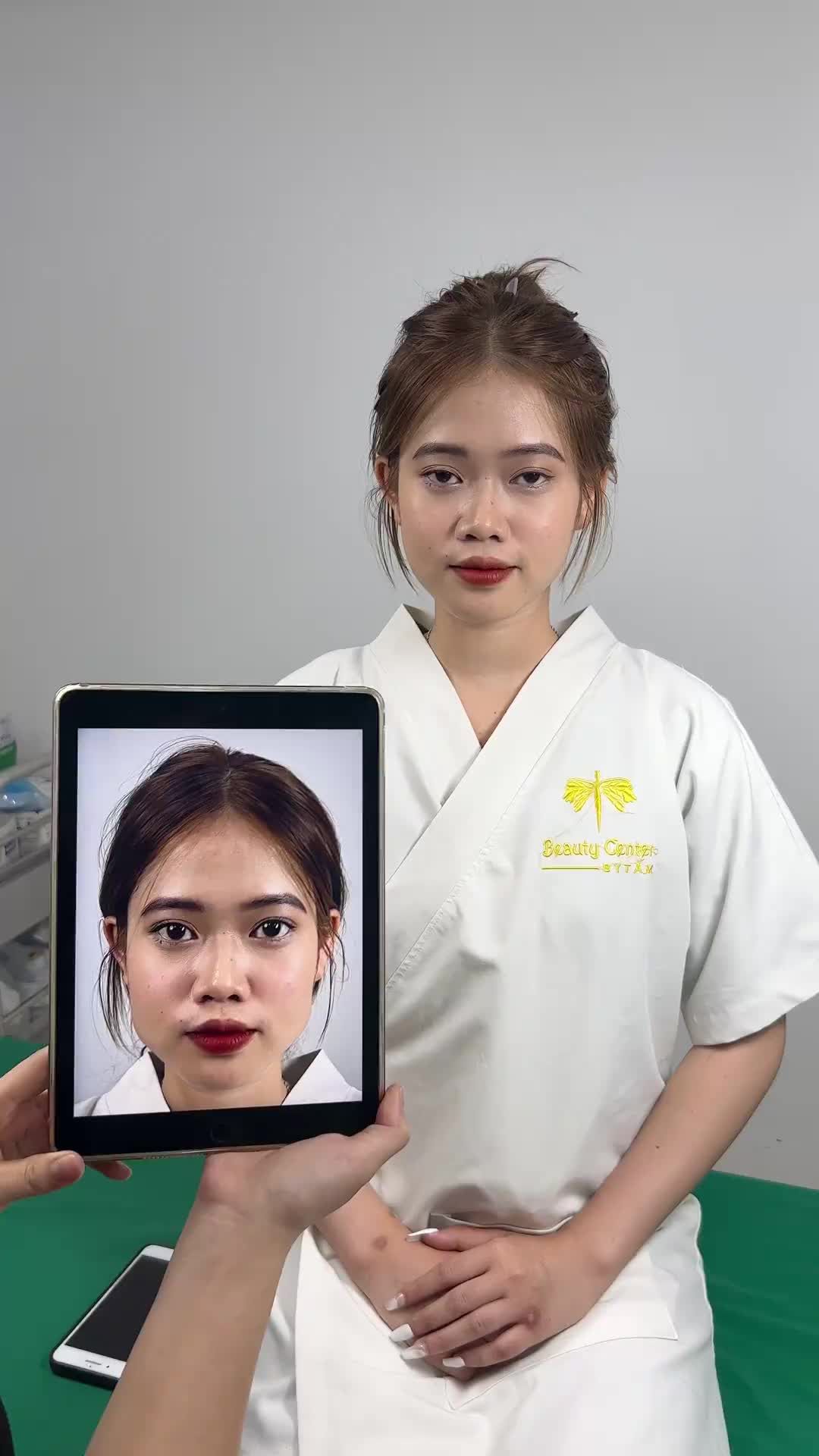 Ca tái khám Vline gọn hàm tại phòng khám TMV Tấm!