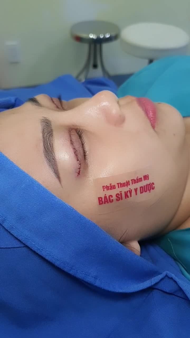 Cắt mí trên + ghép mô mỡ là phương pháp giúp đôi mắt bạn linh hoạt hơn và sống động hơn.