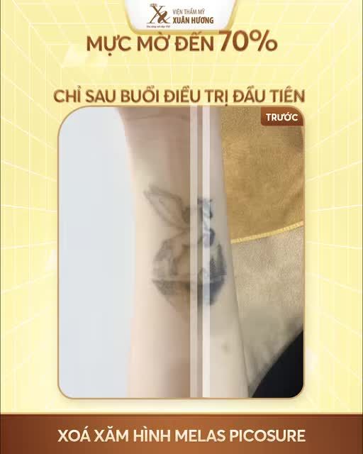 MỰC MỜ NGAY SAU LẦN XÓA XĂM ĐẦU TIÊN VỚI CÔNG NGHỆ MELAS PICOSURE