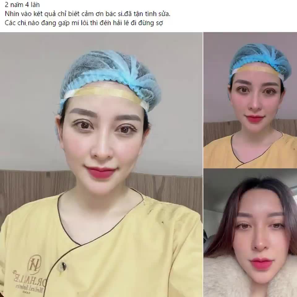 Mắt bên to bên nhỏ, đính cơ nâng mi sau Cắt mí tại các cơ sở thẩm mỹ kém uy tín, cơ sở nào đủ uy tín để sửa lại nếp mí lỗi này?