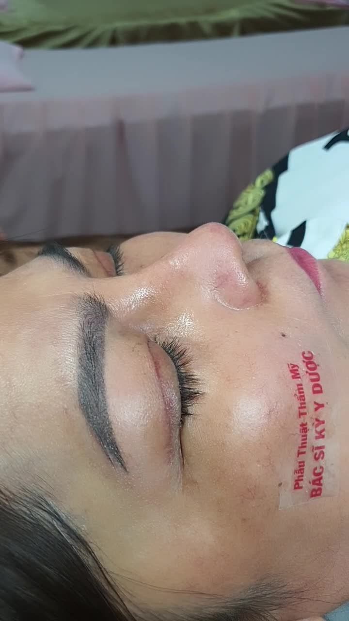 Khắc phục ngay tình trạng: - Bọng mắt lớn khiến mí mắt sụp sệ, khiến đôi mắt như già đi chục tuổi. - Chiếc mũi thấp tẹt, đầu mũi hễnh khiến khuôn mặt kém duyên.