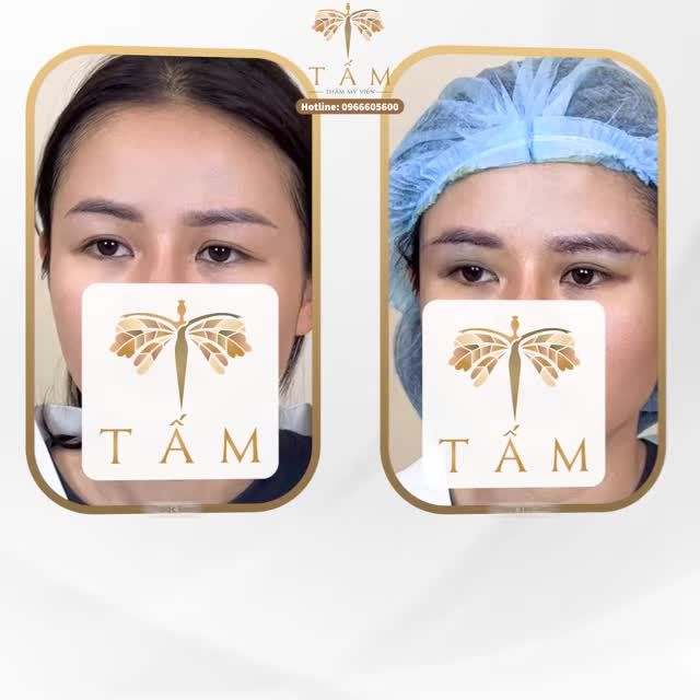 Cùng chị khách chiêm ngưỡng đôi mắt long lanh sau thực hiện Nâng cung chân mày.