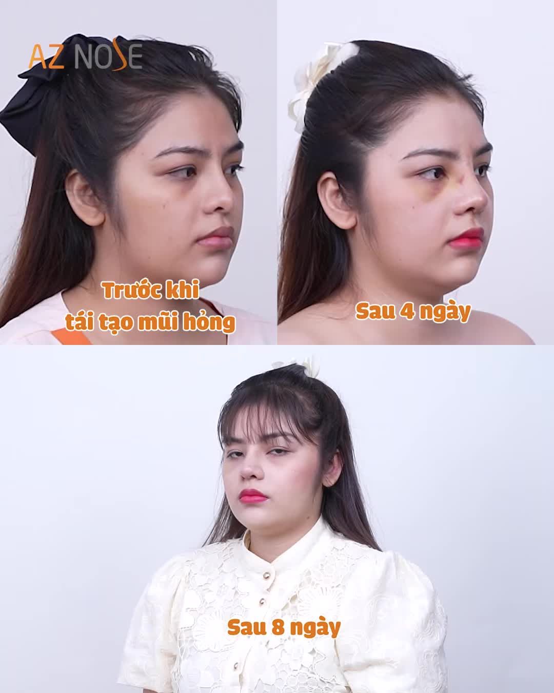 Khách hàng đến từ Cần Thơ đã thay đổi như thế nào sau khi tái tạo mũi h.ỏng?