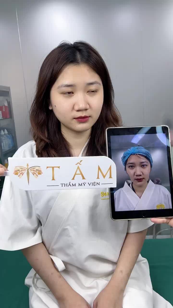 Ca Filler Má tại phòng khám TMV Tấm.