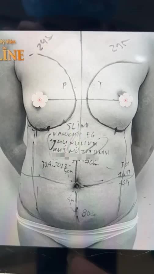 Ngày hôm nay Ekip Sline rực cháy với hơn 10 ca đại phẫu thực hiện combo ngực + bụng :