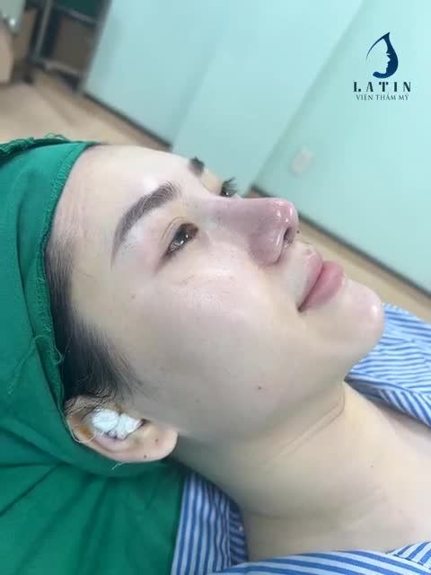 Mũi cấu trúc sửa lại