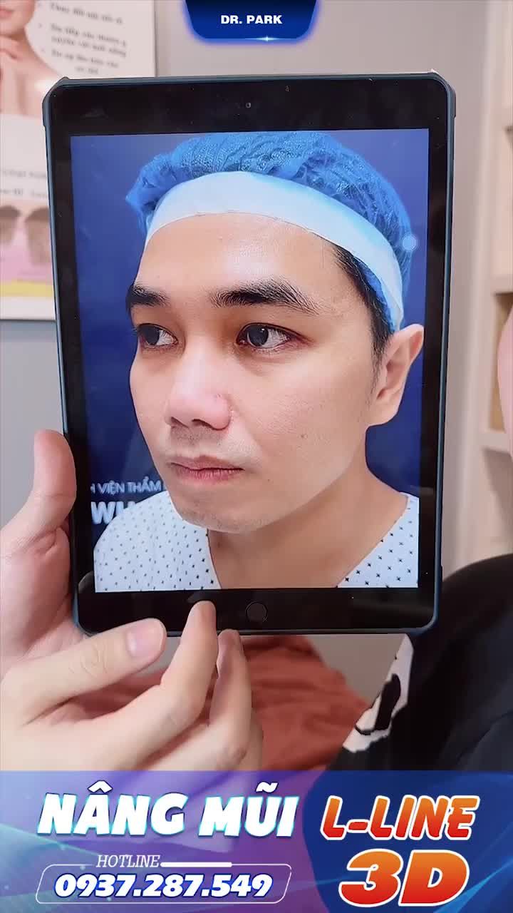 NÂNG MŨI NAM GIỚI NHƯ THẾ NÀO LÀ ĐẸP?