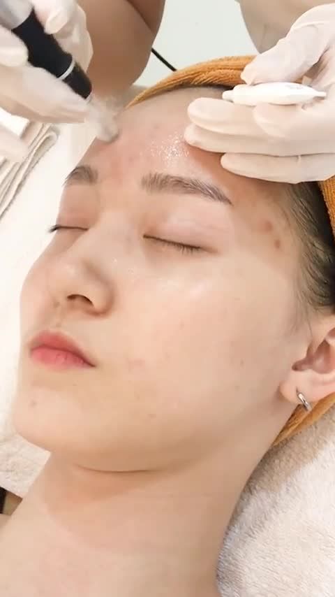 Khách hàng với tình trạng da tổn thương do mụn để lại đang thực hiện liệu trình đưa dưỡng chất vitamin tái tạo, trẻ hóa da tại VTM Xuân Hương.