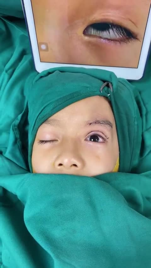 Ca sụp mí bẩm sinh trẻ em vừa được thực hiện bởi ekip Dr. Minh Phạm