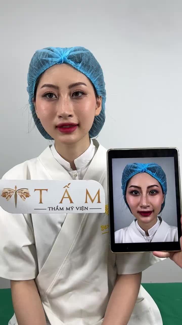 Cận cảnh ca cân chỉnh má cho bạn Hà - khách hàng Filler Má tại phòng khám TMV Tấm.