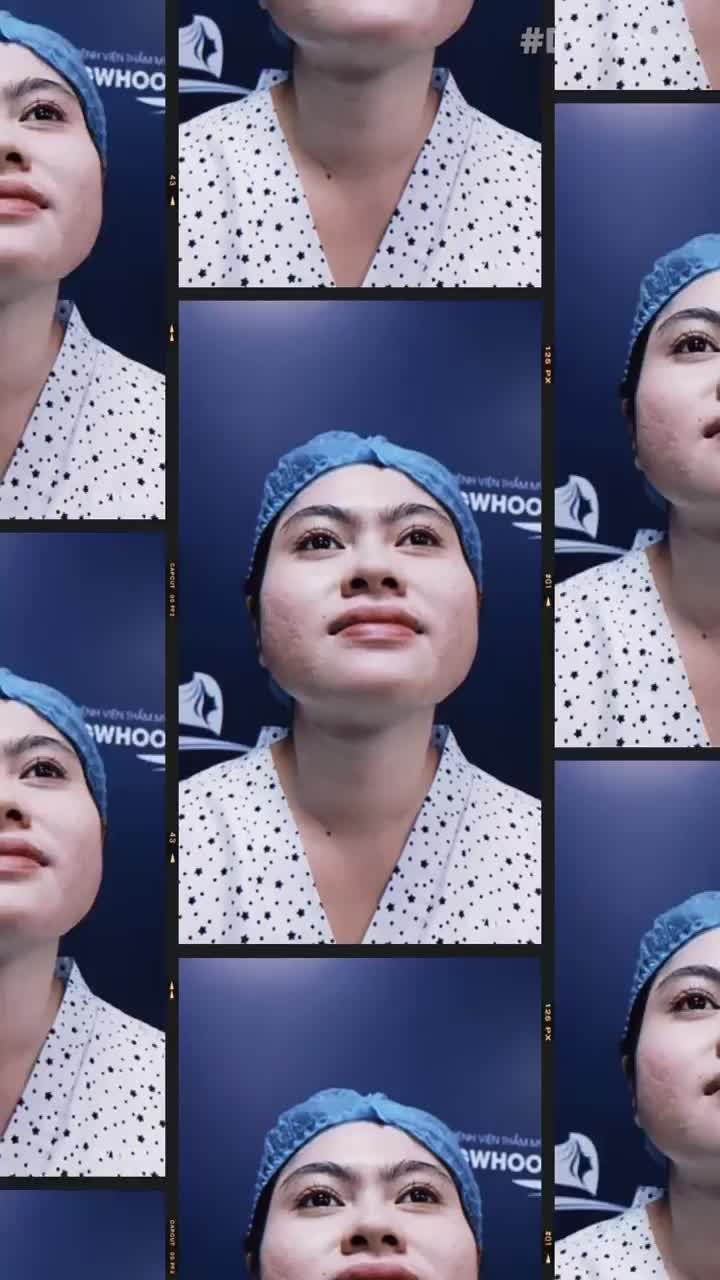 NÂNG MŨI CẤU TRÚC LÀ GÌ?