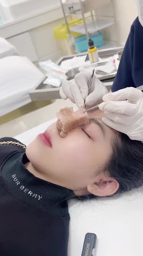 THÁO NẸP NÂNG MŨI CẤU TRÚC  XINH ĐẸP NGAY SAU 10 NGÀY
