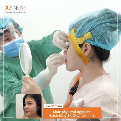 Cải thiện mũi ng.ắn, miệng m.óm sau khi nâng mũi cấu trúc