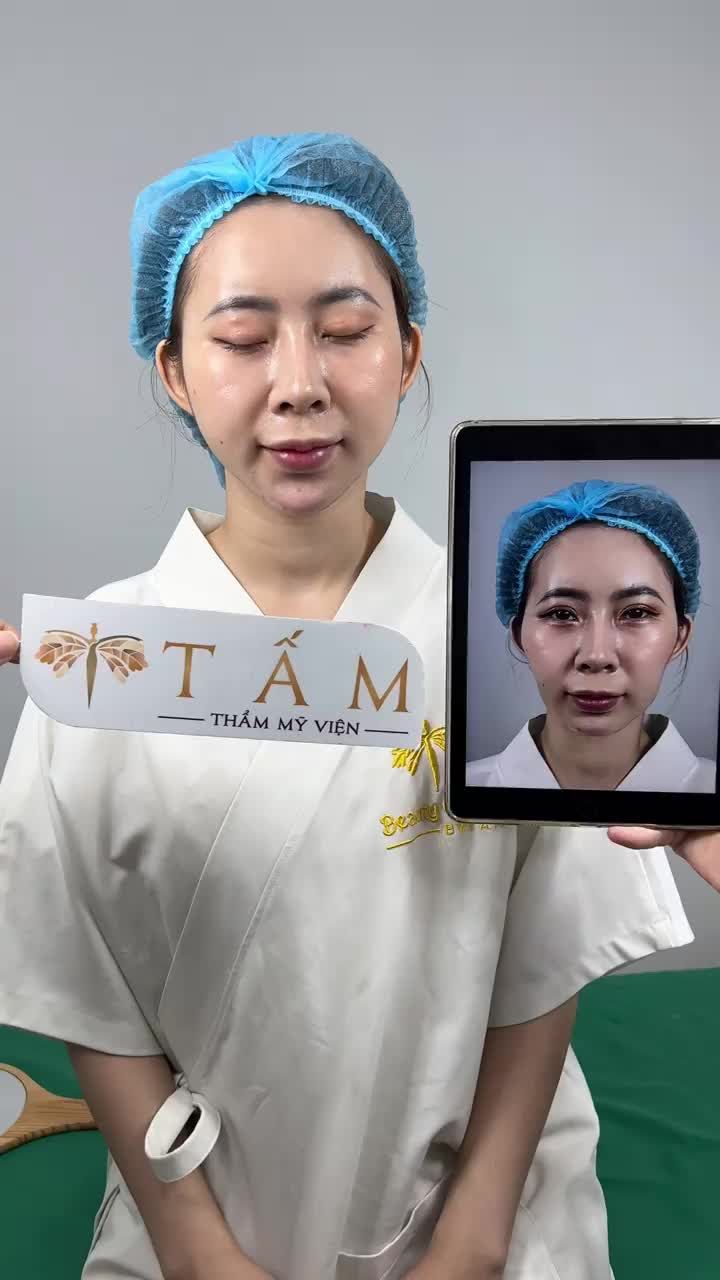 “Dù ai nói ngả nói nghiêng thì combo filler vẫn là chân ái của em nha mọi người” bạn Hương chia sẻ sau khi sử dụng combo filler thái dương, cằm, má tại Tấm.