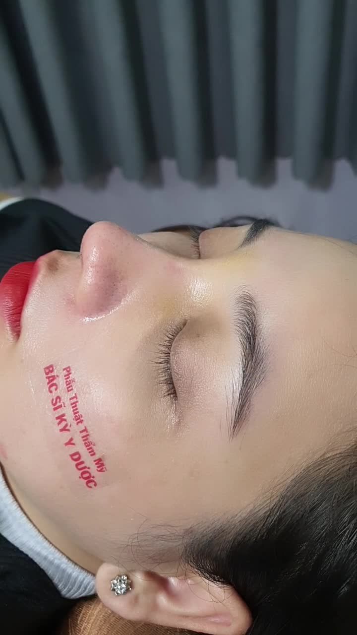 Trở lại tái khám sau 10 ngày Nâng Mũi ALINE Bán Cấu Trúc 2 Lớp