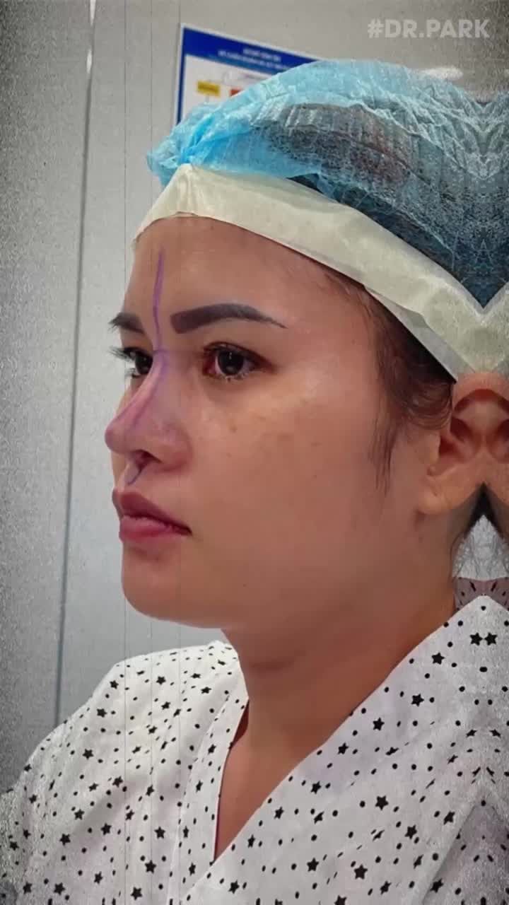 NÂNG MŨI CẤU TRÚC - BẠN ĐÃ HIỂU HẾT VỀ PHƯƠNG PHÁP NÀY??