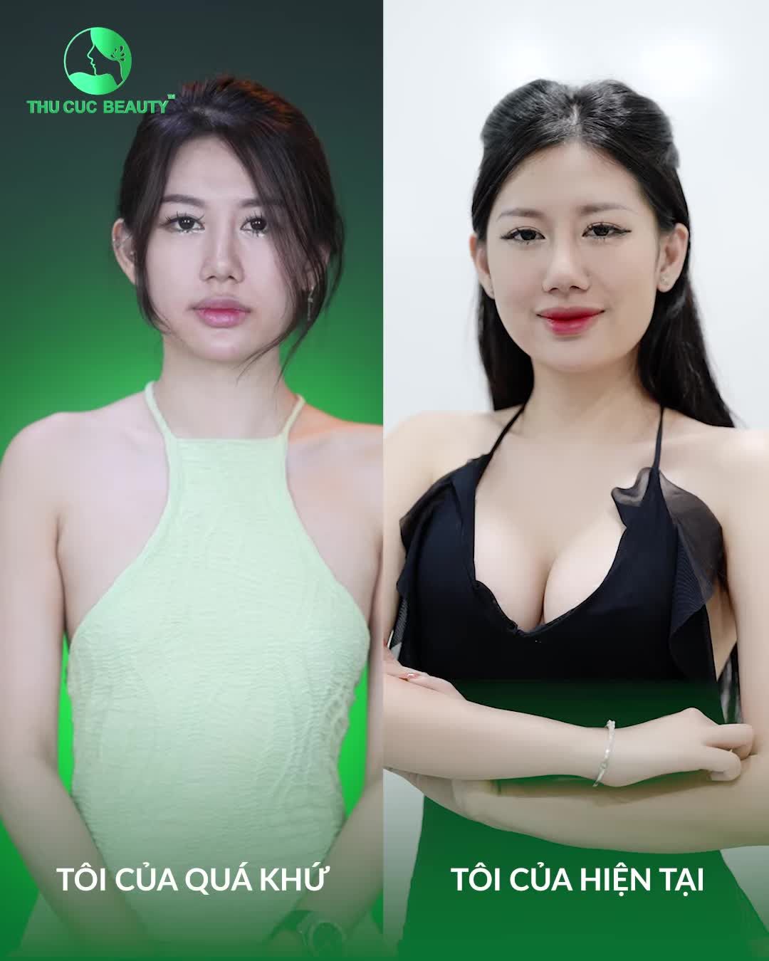 Duy nhất tháng này Nâng ngực TC giảm đến 50% chào hè