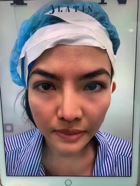 Mũi trước của em gái đã nâng bọc sụn được 1 năm nhưng bị lệch rõ, đúng kiểu mũi mọc từ trán cao thô, không đều nhau, lộ sóng rõ ràng.