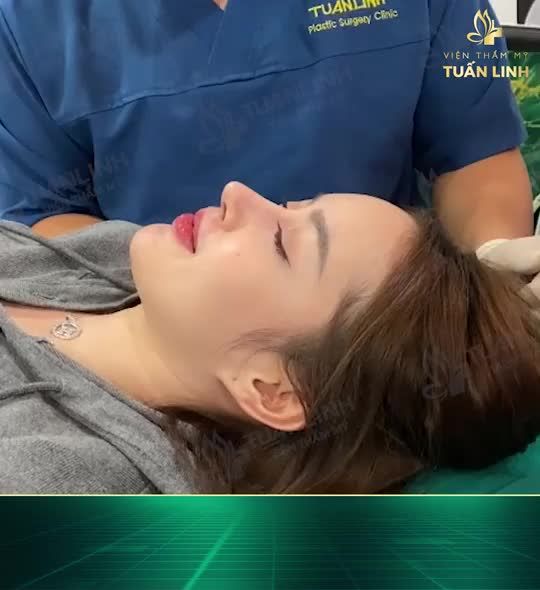 Nâng mũi cấu trúc Surgiform ( mũi sửa lại) sau 4 tháng đẹp xuất sắc cho bạn gái đến từ Campuchia!!
