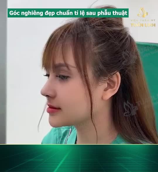 CHIẾC MŨI CẤU TRÚC ĐẸP XUẤT SẮC NGAY SAU PHẪU THUẬT!!