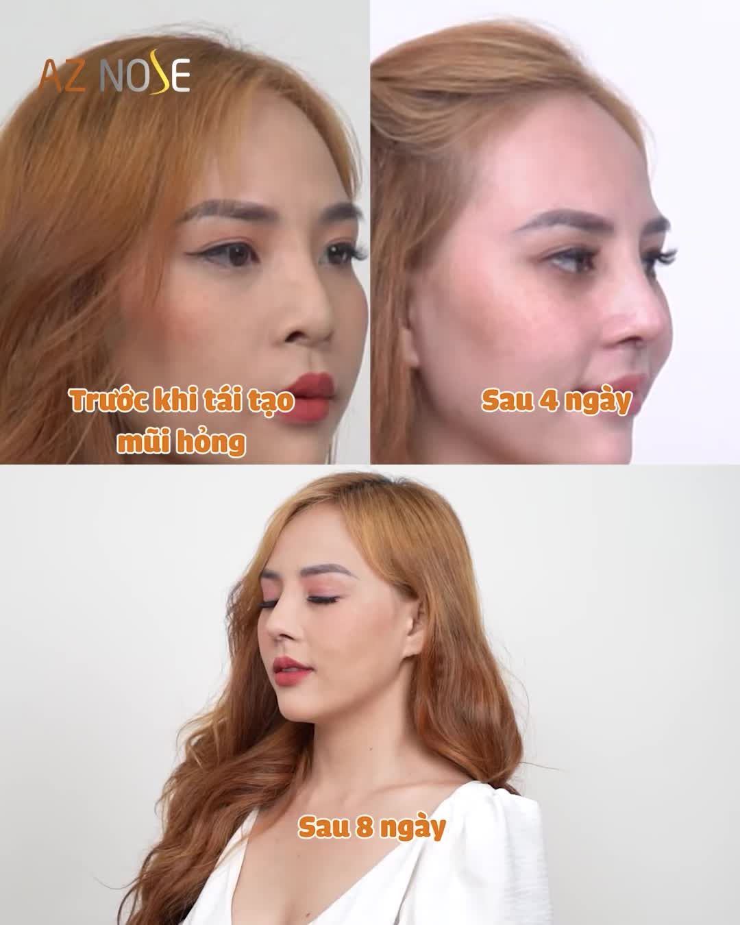 Chiếc mũi c.ụp thay đổi thế nào sau 1 năm phẫu thuật