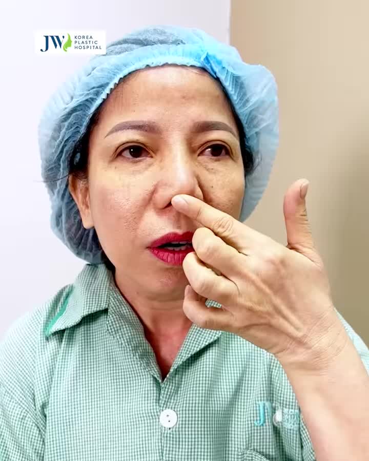Bác sĩ Tú Dung Nâng mũi sụn sườn trùng tu MŨI CO RÚT, VẸO LỆCH 20 năm hóa S Line ĐẸP HẾT NƯỚC CHẤM
