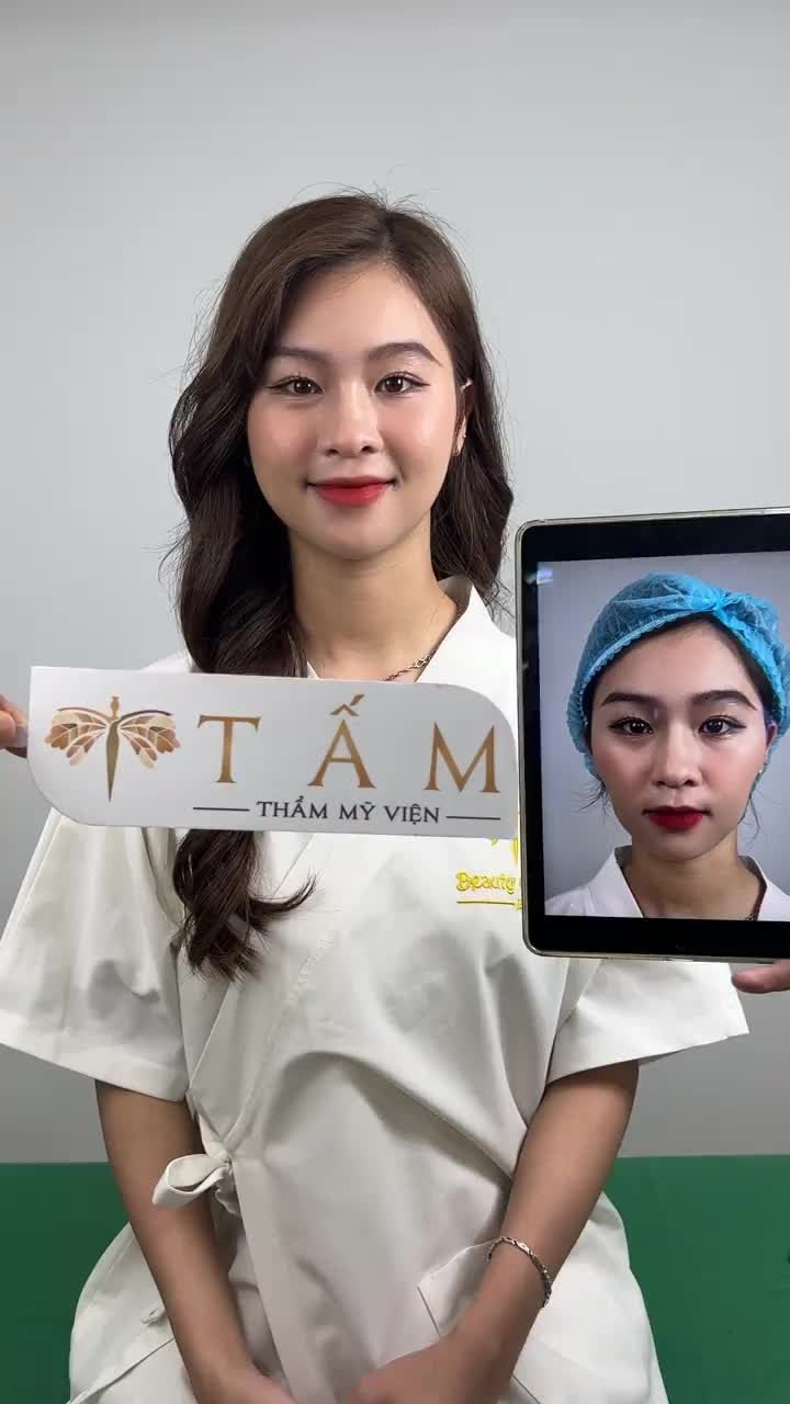 Ca Filler Má tại phòng khám TMV Tấm.