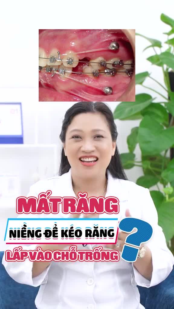 MẤT RĂNG, NIỀNG KÉO RĂNG LẤP VÀO CHỖ TRỐNG ĐƯỢC KHÔNG?
