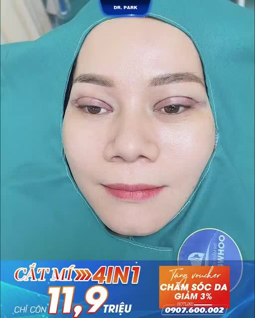 VÌ SAO CHỊ EM NÊN LỰA CHỌN CẮT MÍ 4 IN 1