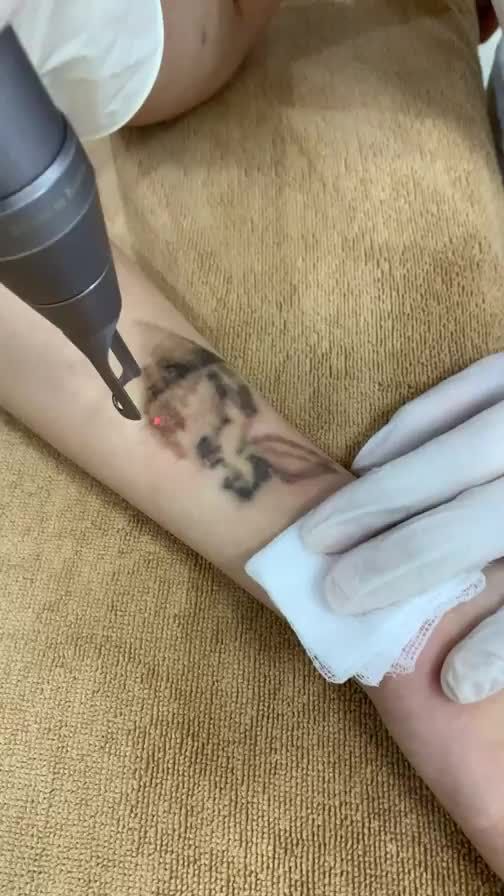 Xoá xăm buổi thứ 2 cho chị khách hàng đến từ Hà Nội