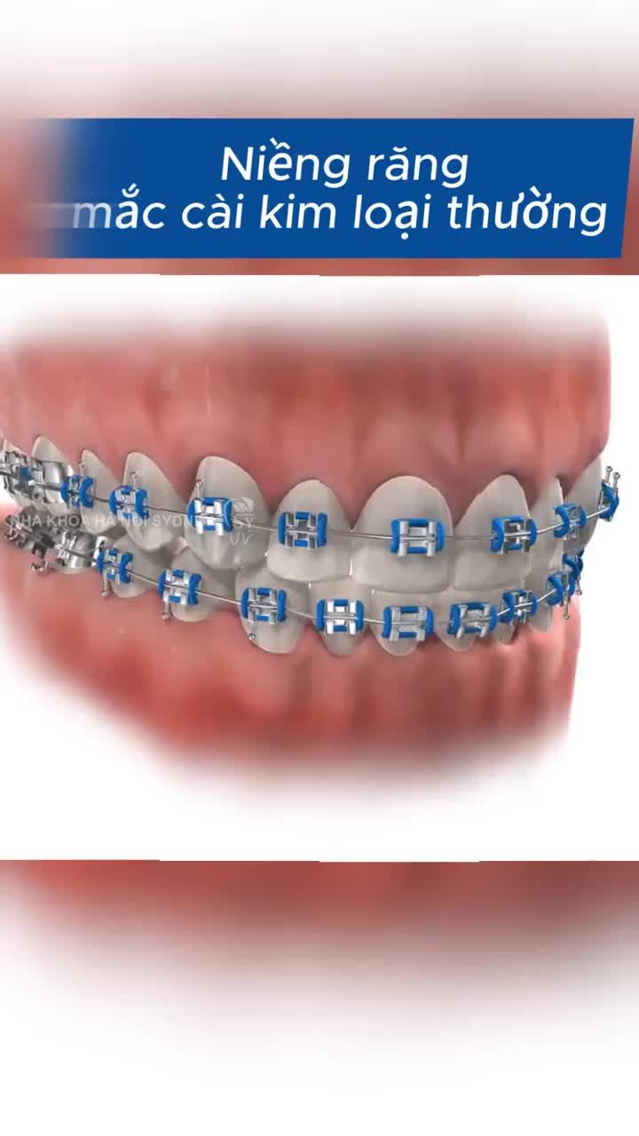 Niềng răng hết bao nhiêu tiền?