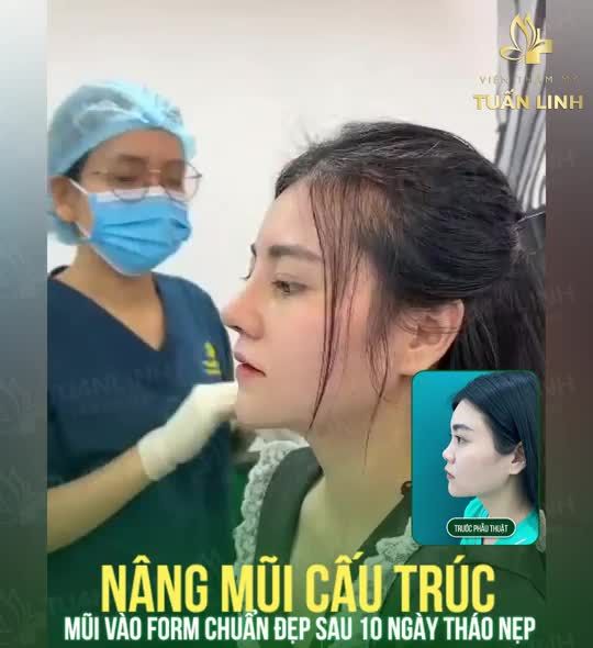 NÂNG MŨI - NÂNG THẦN THÁI XINH ĐẸP TỰ TIN.