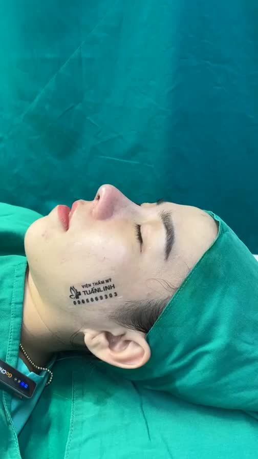 Case mũi cấu trúc vừa hoàn thành