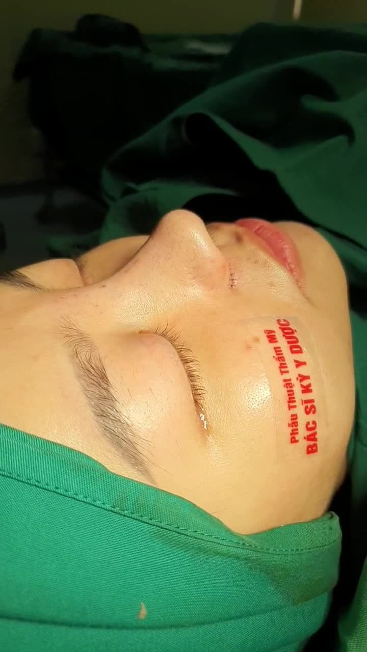 Chỉ sau 45 phút phẫu thuật Nâng Mũi Aline Bán Cấu Trúc Đa Lớp kết hợp với Thu Cánh Mũi, Bác sĩ Kỳ Y Dược đã giúp chị khách tại Nha Trang có ngay dáng mũi: