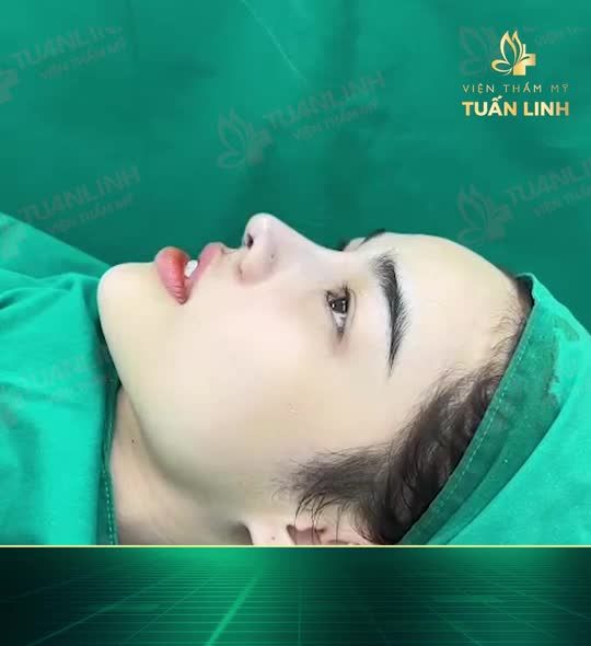 Nâng mũi không sưng đau, 3 ngày ổn định, ''lột xác'' hoàn toàn diện mạo khuôn mặt Chính là phương pháp nâng mũi cấu trúc.
