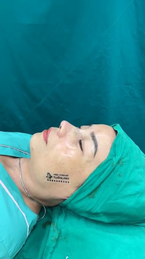Case mũi cấu trúc surgiform vừa hoàn thành