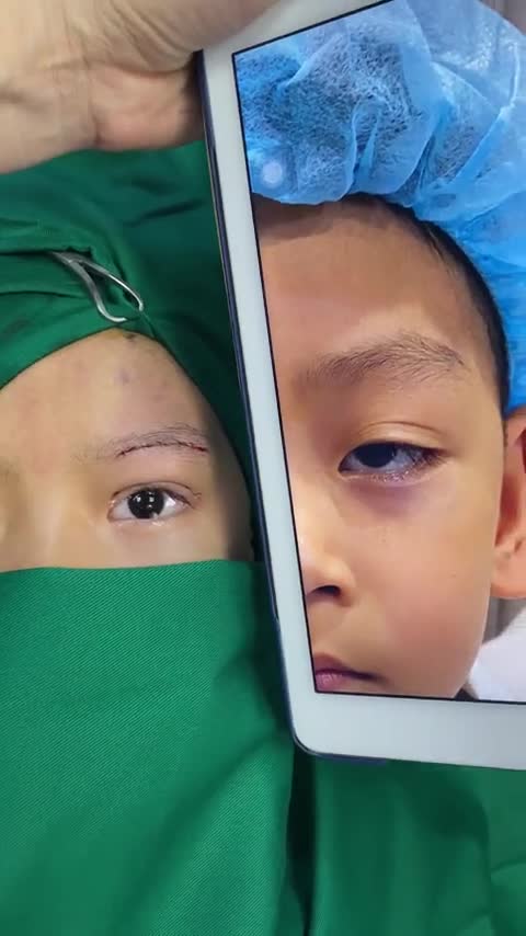 Ca sụp mí bẩm sinh nặng ở trẻ em vừa được thực hiện bởi ekip Dr. Minh Phạm