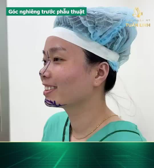Xinh đẹp trẻ trung hơn, sang hơn, đẹp sắc nét, thanh tú hơn sau 120 phút với combo Nâng mũi cấu trúc + Độn cằm Vline tại Tuấn Linh.