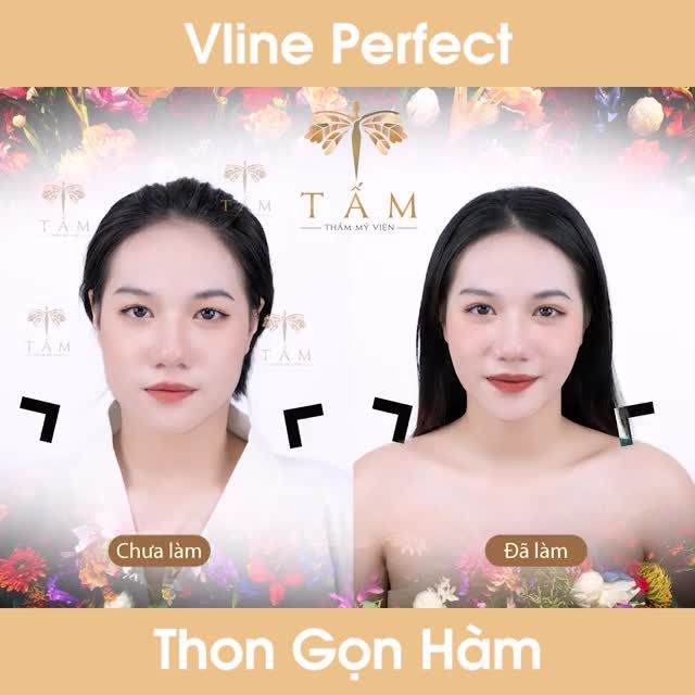 MẶT CHUẨN VLINE ĐEM LẠI TỰ TIN CHO NÀNG