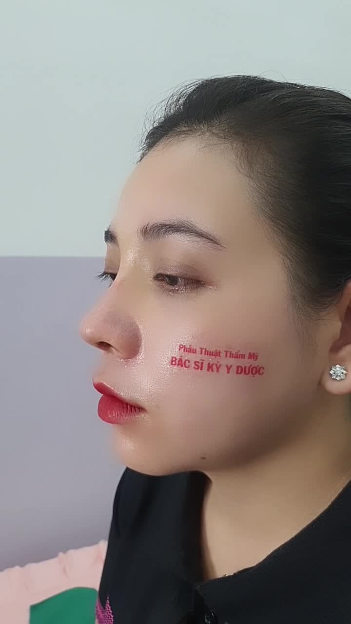 Chỉ sau 14 ngày Nâng Mũi ALINE Bán Cấu Trúc 2 Lớp, bạn khách đã sở hữu ngay: