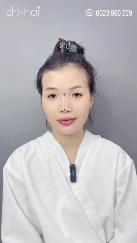 NÂNG MŨI CẤU TRÚC - CẢI THIỆN MŨI THẤP, NGẮN