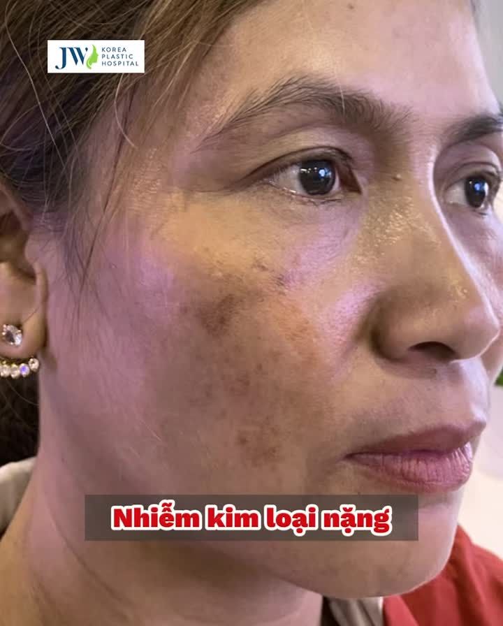 Tuyệt vời: Quý bà U40 DA SẠCH NÁM. Trắng hồng MỊN MÀNG sau khi đến Bệnh viện JW