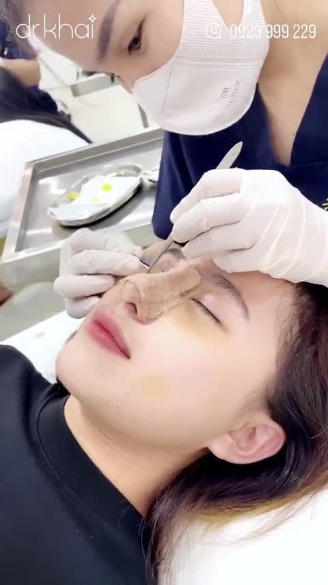 SỞ HỮU GÓC NGHIÊNG "THẦN THÁNH" SAU KHI NÂNG MŨI CẤU TRÚC 7 NGÀY