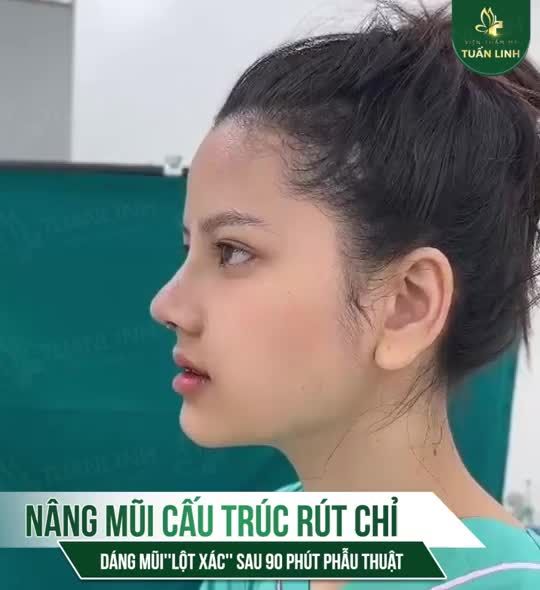Đã từng nâng mũi chỉ được 3 năm nhưng bị: bao xơ, mô thịt đầu mũi dày, sống mũi thấp, gãy võng nhiều giữa hai hốc mắt, hai cánh mũi không đều nhau.