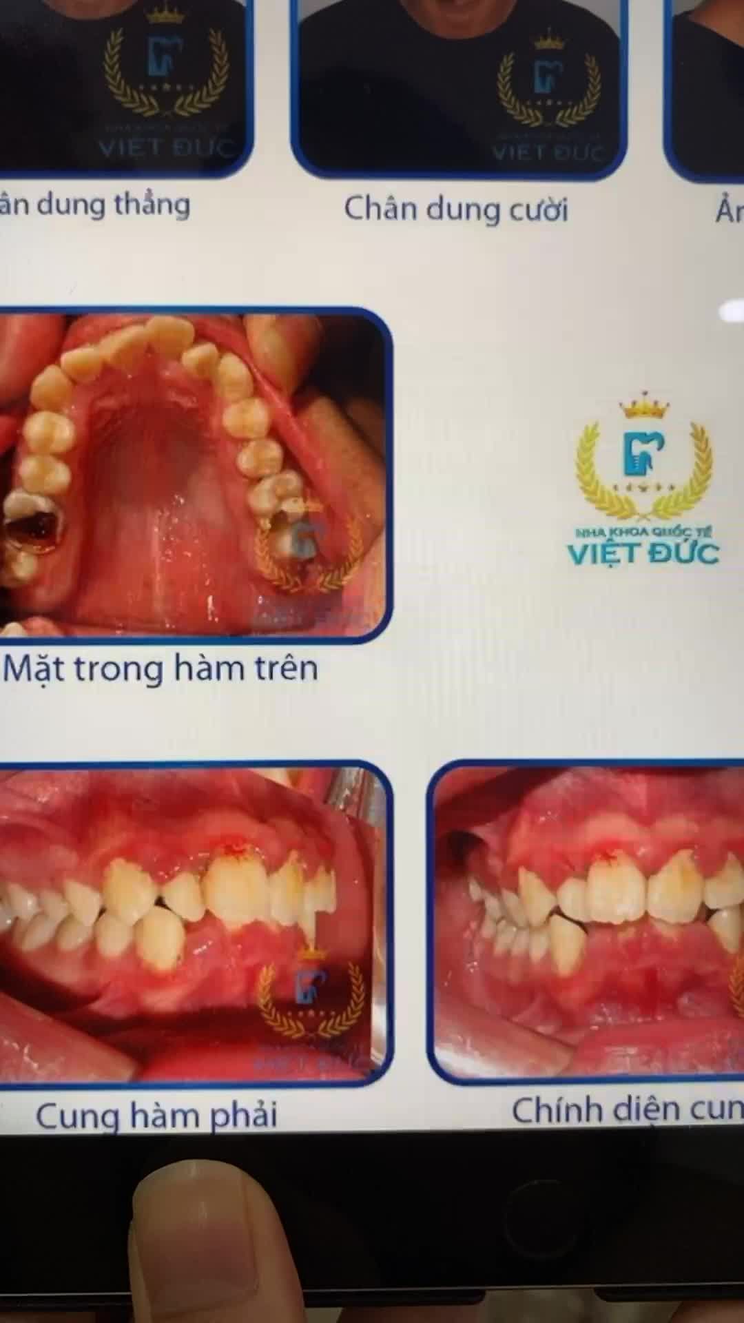 THAY ĐỔI CỦA KHÁCH HÀNG SAU 2 NĂM NIỀNG RĂNG THAY ĐỔI BẤT NGỜ