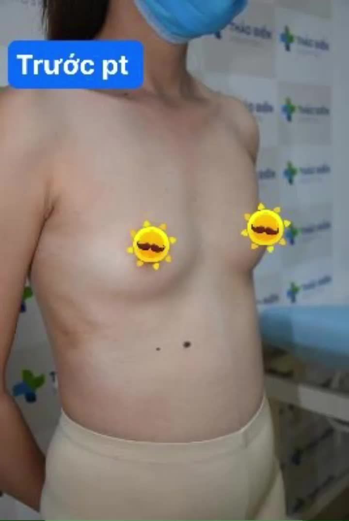 NÂNG NGỰC TẠO KHE  - TỰ TIN DIỆN BIKINI KHOE DÁNG CHUẨN